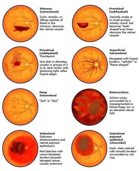 Retinal Bleeding: Symptoms, Causes, Diagnosis, and。